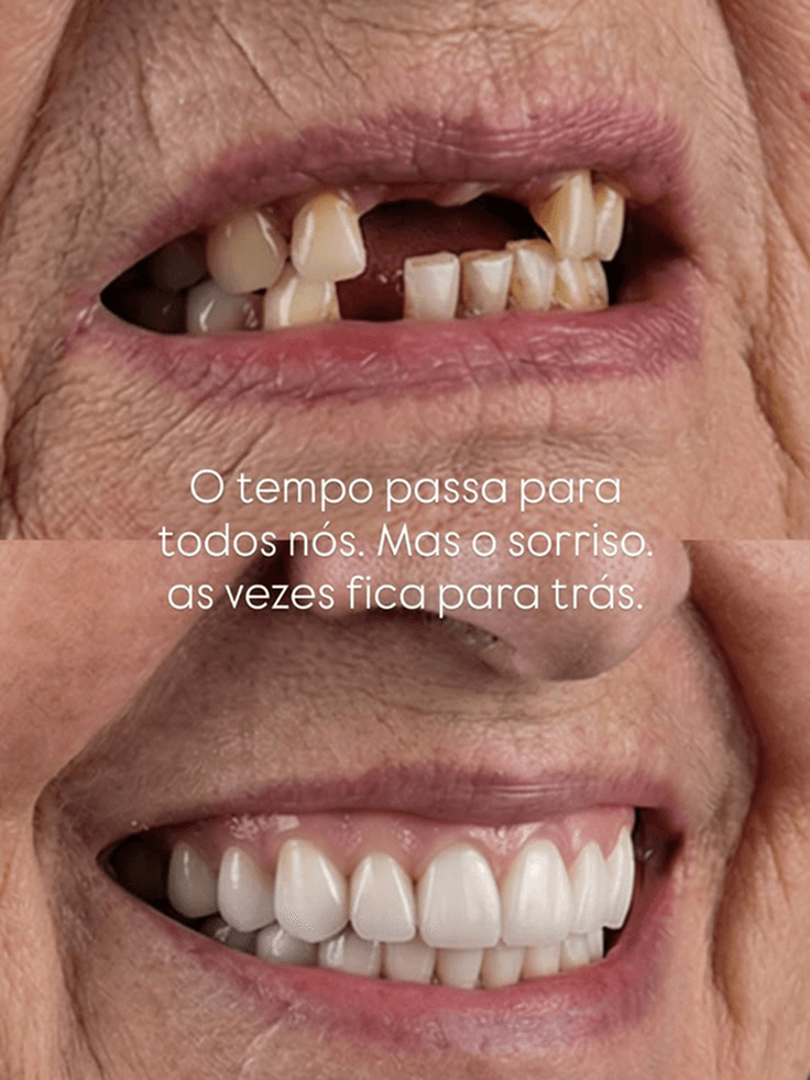 Caso clínico de Rinomodelación funcional y estética — Dra. Margaret Narváez