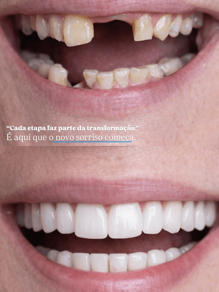 Caso clínico de Aclaramiento y estética dental — Dra. Margaret Narváez